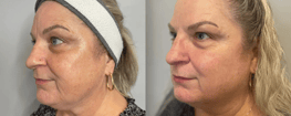 laser resurfacing results