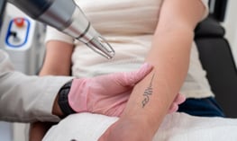 tattoo removal before and after  