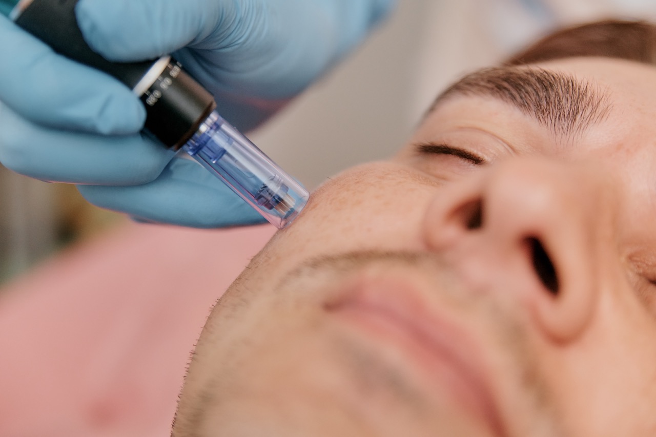 Can Men Benefit from Microneedling Treatments?