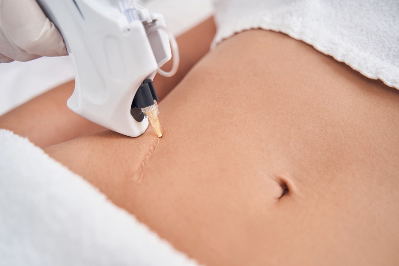 How Scar Removal Can Help Improve Your Confidence
